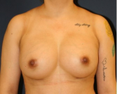 Feel Beautiful - Breast Augmentation 132 - After Photo